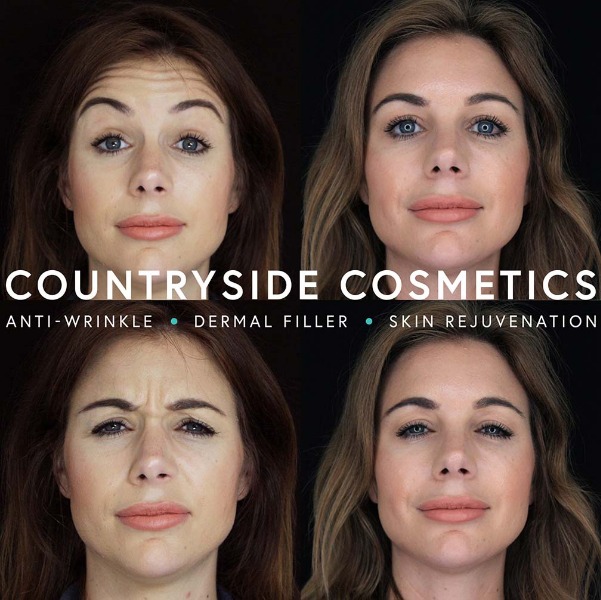Upper facial Botox to reduce fine lines and wrinkles